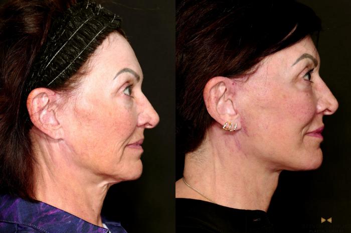Before & After Facial Fat Grafting Case 712 Right Side View in Fort Worth & Arlington, Texas