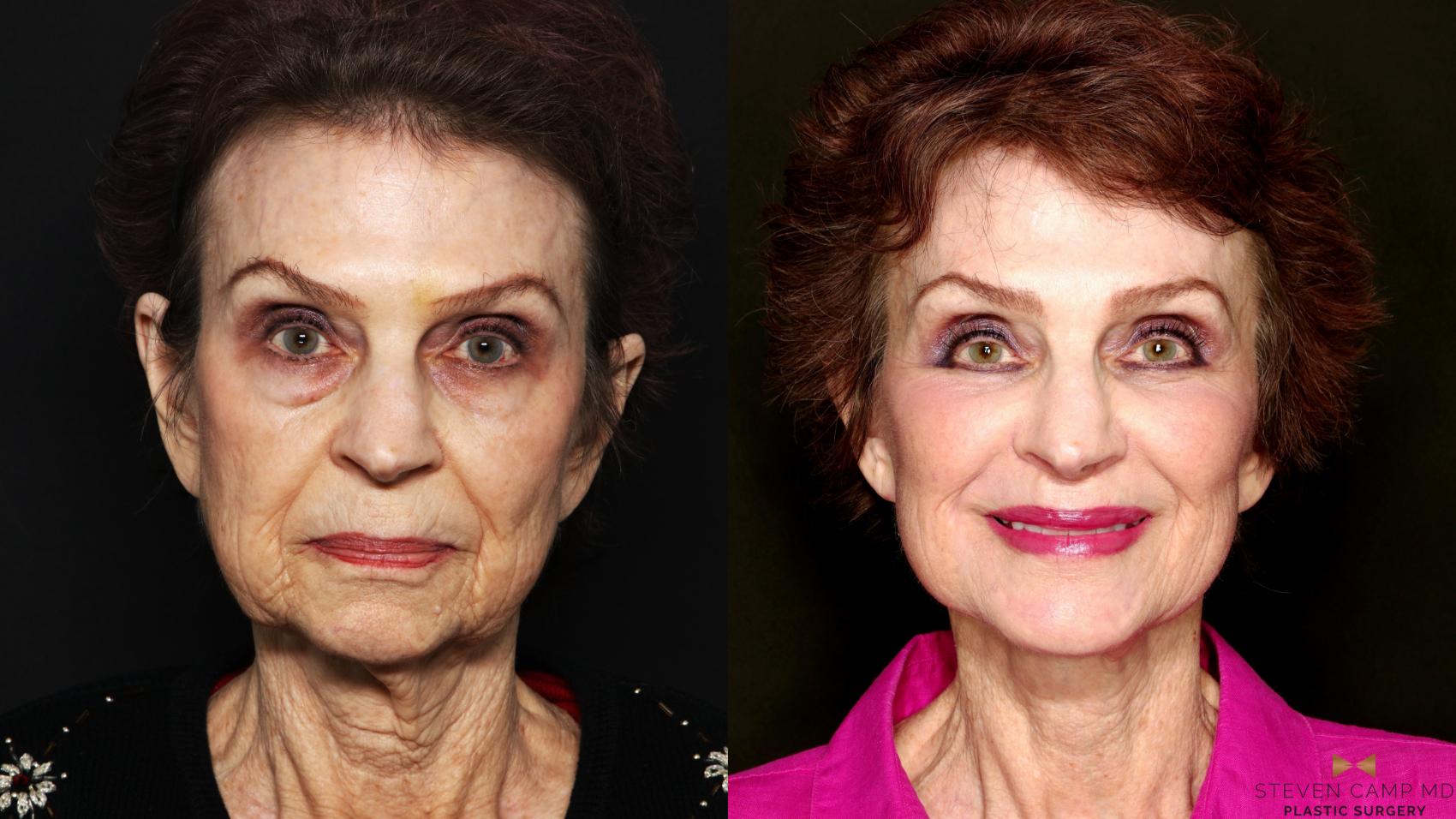 Before & After Deep Plane Facelift Case 714 Front View in Fort Worth & Arlington, Texas