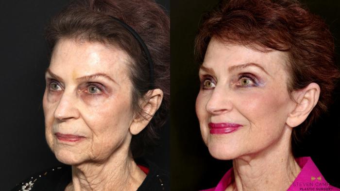 Before & After Deep Plane Facelift Case 714 Left Oblique View in Fort Worth & Arlington, Texas