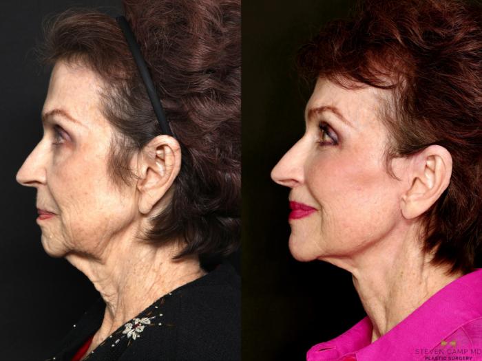 Before & After Deep Plane Facelift Case 714 Left Side View in Fort Worth & Arlington, Texas