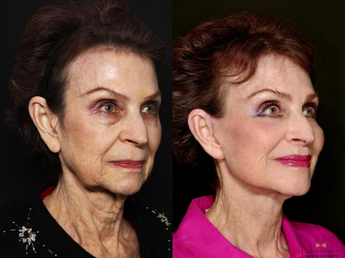 Before & After Deep Plane Facelift Case 714 Right Oblique View in Fort Worth & Arlington, Texas