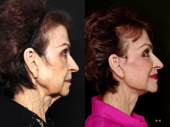 Before & After Deep Plane Facelift Case 714 Right Side View in Fort Worth & Arlington, Texas