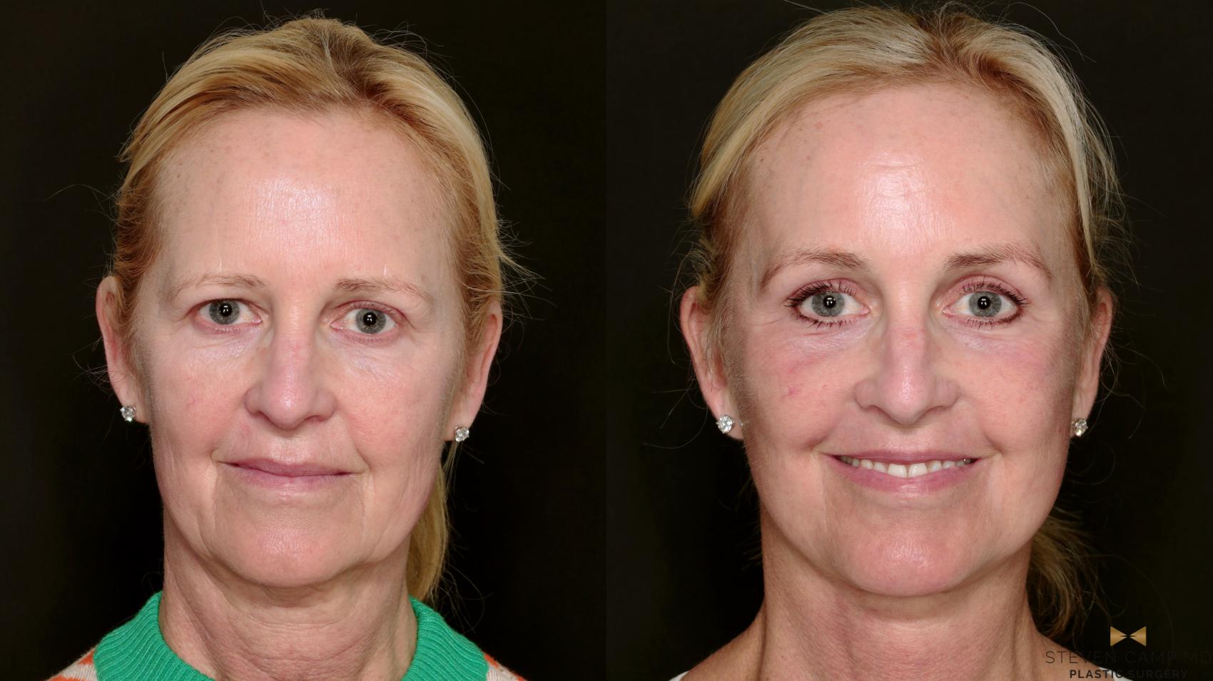 Before & After Deep Plane Facelift Case 715 Front View in Fort Worth & Arlington, Texas