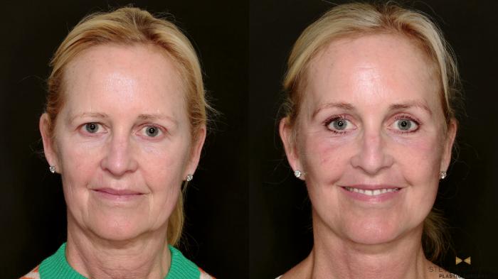 Before & After Deep Plane Facelift Case 715 Front View in Fort Worth & Arlington, Texas