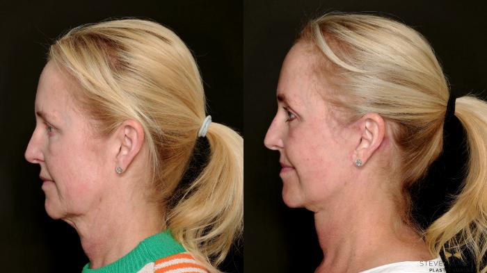 Before & After Deep Plane Facelift Case 715 Left Side View in Fort Worth & Arlington, Texas