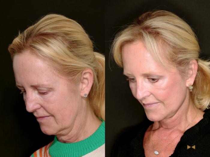 Before & After Deep Plane Facelift Case 715 Looking Down Oblique Left View in Fort Worth & Arlington, Texas