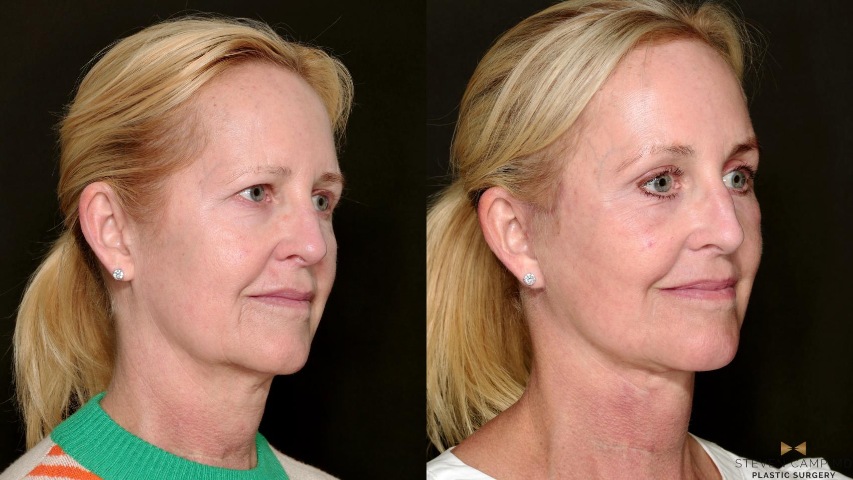 Before & After Deep Plane Facelift Case 715 Right Oblique View in Fort Worth & Arlington, Texas