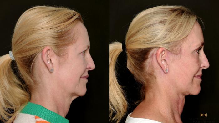 Before & After Deep Plane Facelift Case 715 Right Side View in Fort Worth & Arlington, Texas