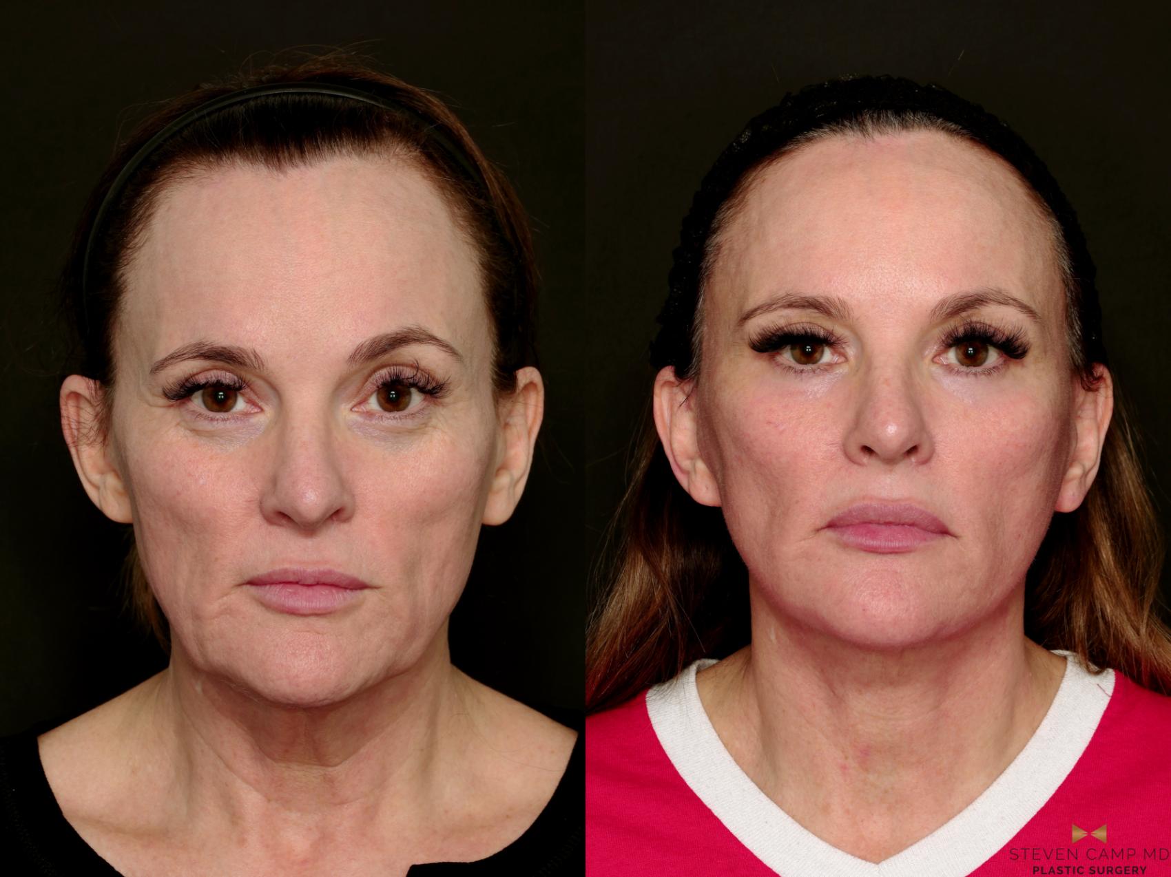 Before & After Deep Plane Facelift Case 716 Front View in Fort Worth & Arlington, Texas