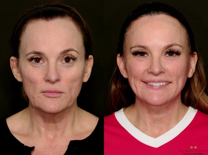 Before & After Deep Plane Facelift Case 716 Frontal Smiling View in Fort Worth & Arlington, Texas