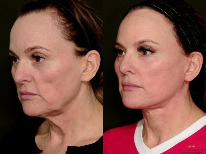 Before & After Deep Plane Facelift Case 716 Left Oblique View in Fort Worth & Arlington, Texas