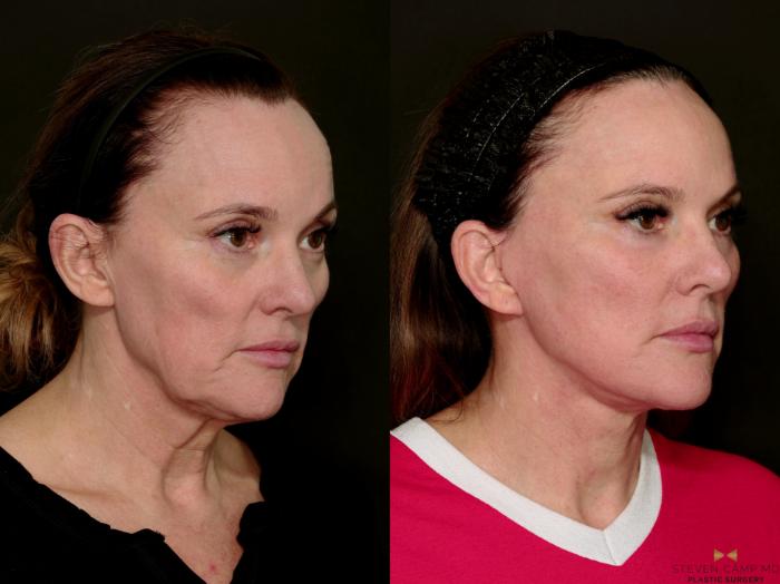 Before & After Deep Plane Facelift Case 716 Right Oblique View in Fort Worth & Arlington, Texas