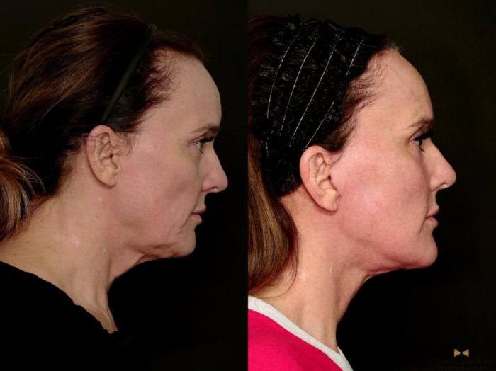 Before & After Deep Plane Facelift Case 716 Right Side View in Fort Worth & Arlington, Texas