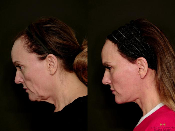 Before & After Deep Plane Facelift Case 716 Side Looking Down Left View in Fort Worth & Arlington, Texas