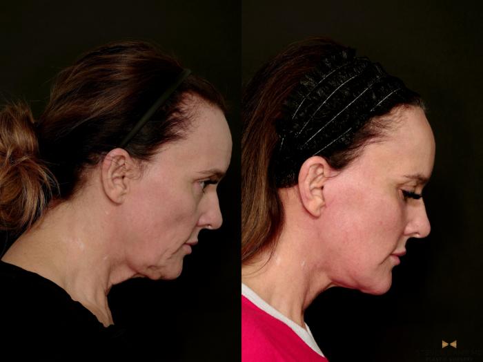 Before & After Deep Plane Facelift Case 716 Side Looking Down Right View in Fort Worth & Arlington, Texas