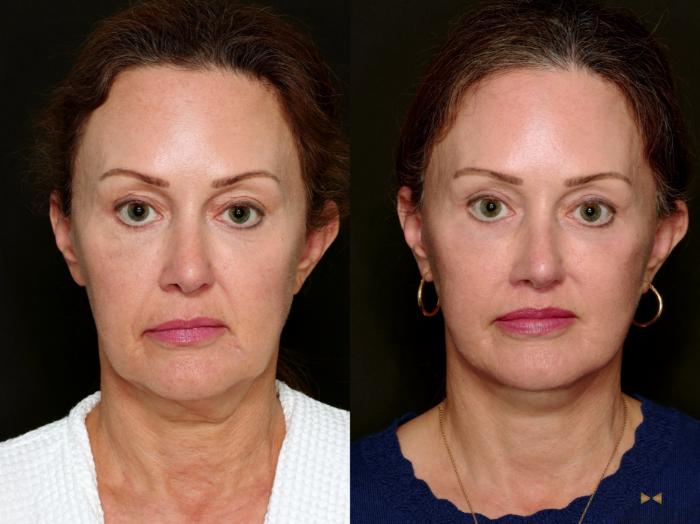 Before & After Deep Plane Facelift Case 718 Front View in Fort Worth & Arlington, Texas