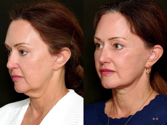 Before & After Deep Plane Facelift Case 718 Left Oblique View in Fort Worth & Arlington, Texas