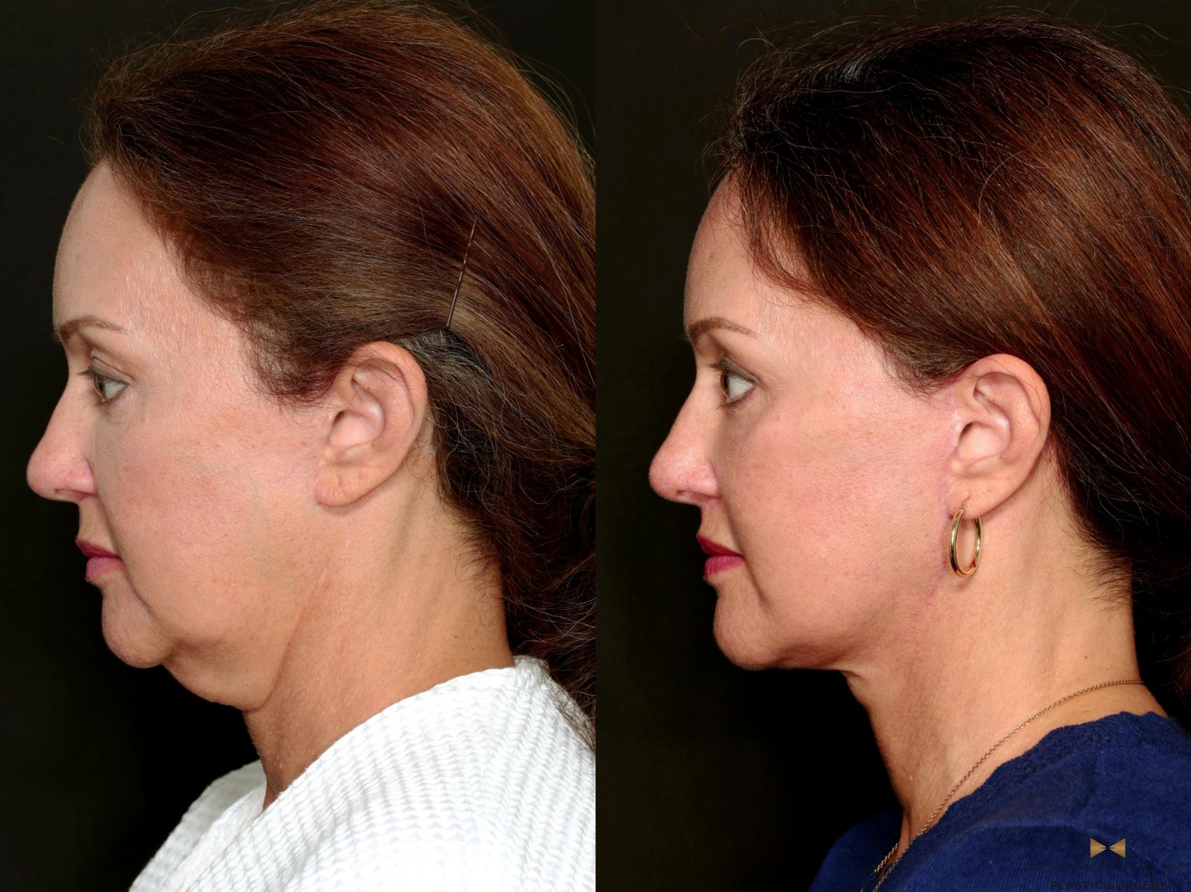 Before & After Deep Plane Facelift Case 718 Left Side View in Fort Worth & Arlington, Texas