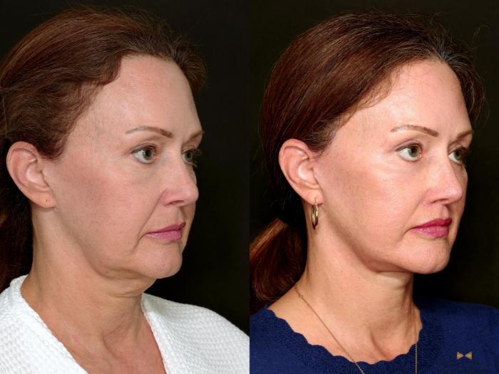 Before & After Deep Plane Facelift Case 718 Right Oblique View in Fort Worth & Arlington, Texas