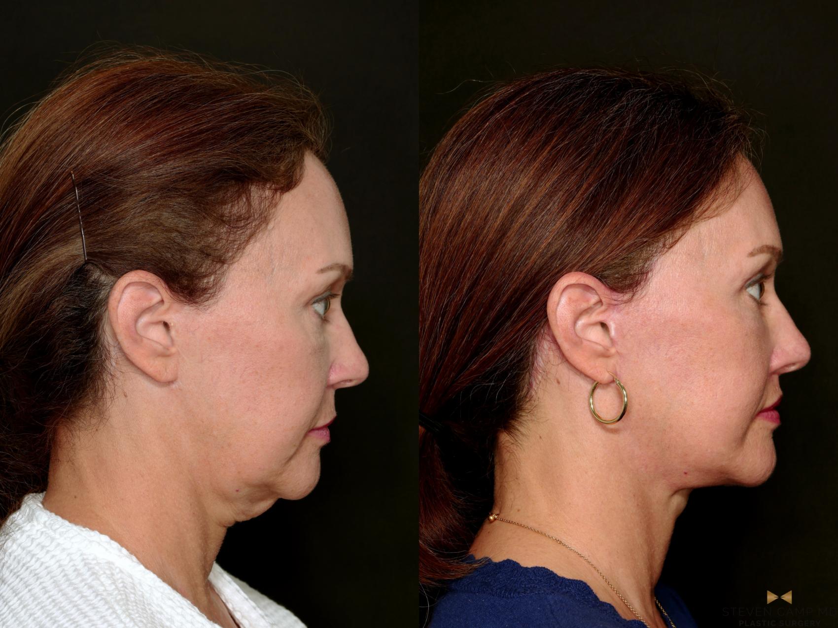 Before & After Deep Plane Facelift Case 718 Right Side View in Fort Worth & Arlington, Texas