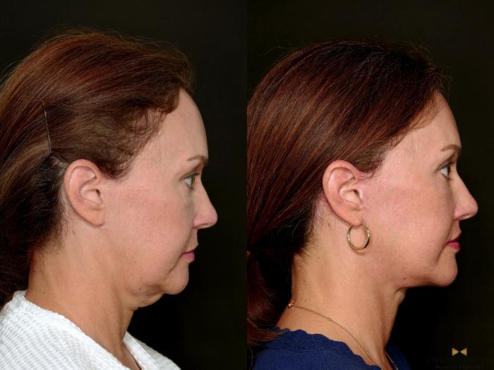 Before & After Deep Plane Facelift Case 718 Right Side View in Fort Worth & Arlington, Texas
