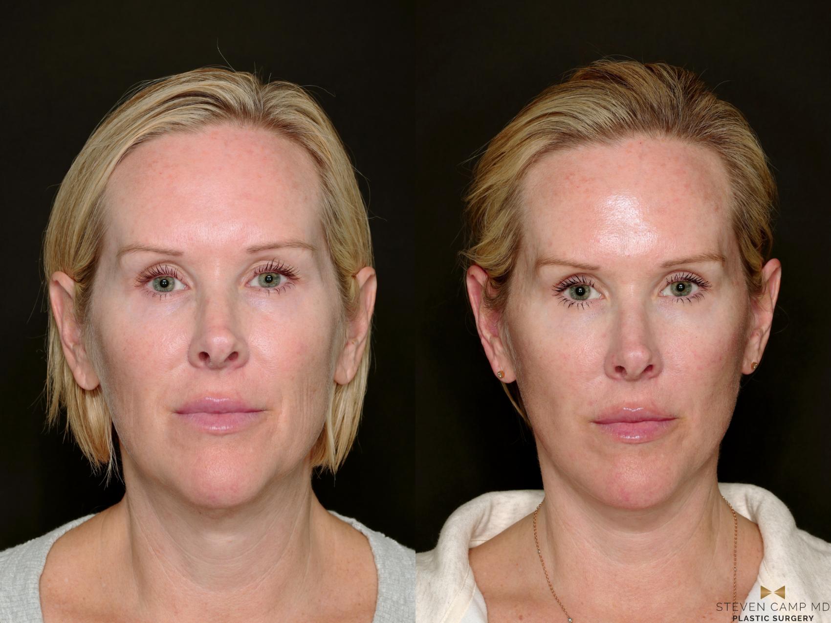 Before & After Deep Plane Facelift Case 722 Front View in Fort Worth & Arlington, Texas