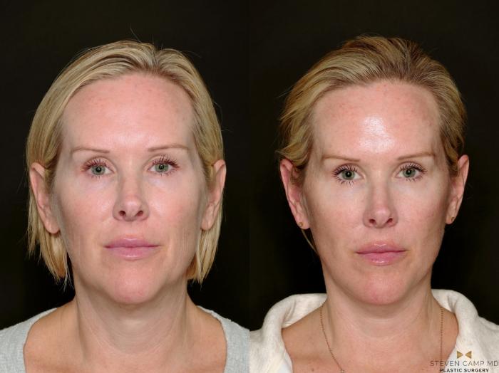 Before & After Deep Plane Facelift Case 722 Front View in Fort Worth & Arlington, Texas