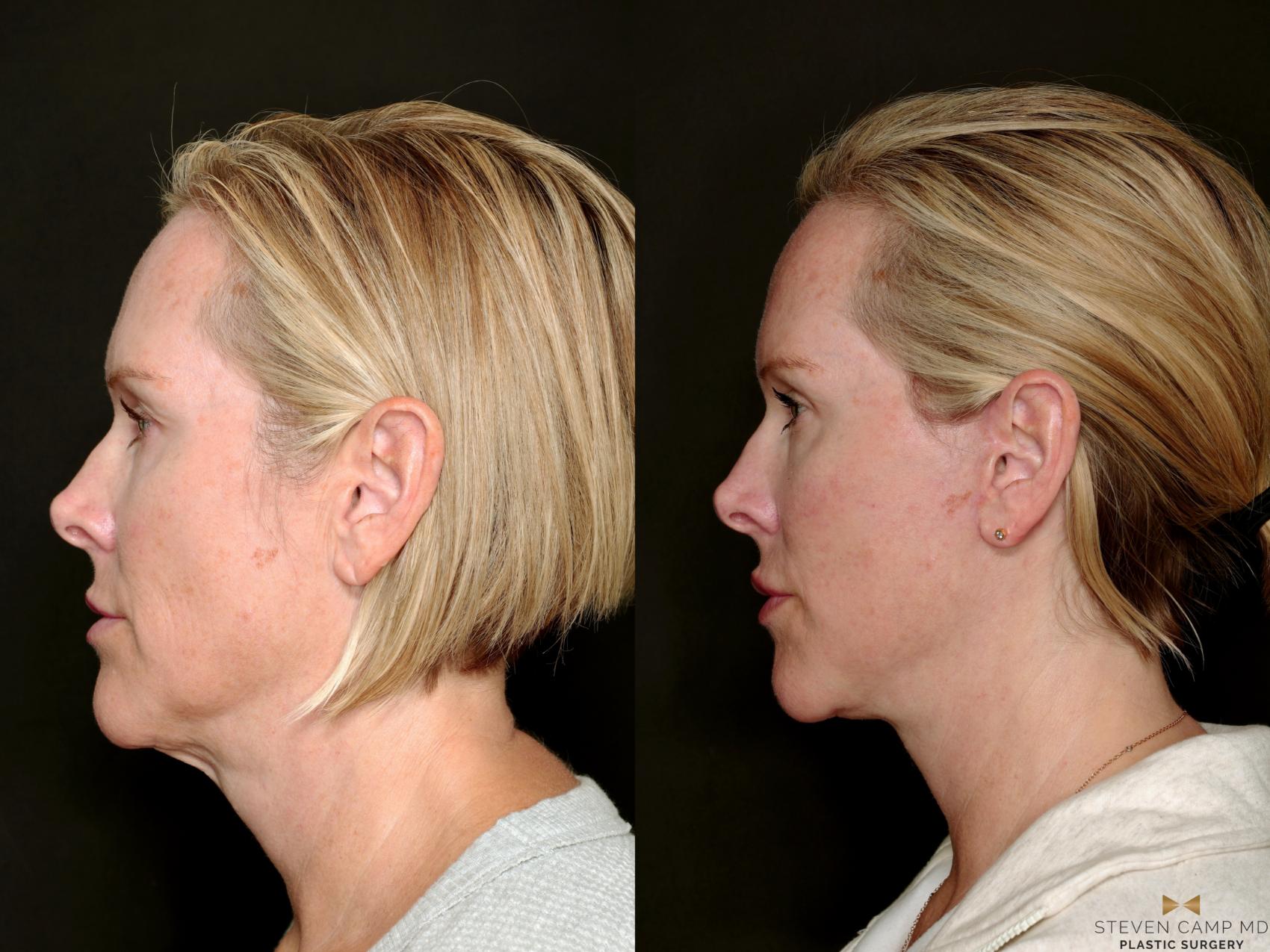 Before & After Deep Plane Facelift Case 722 Left Side View in Fort Worth & Arlington, Texas