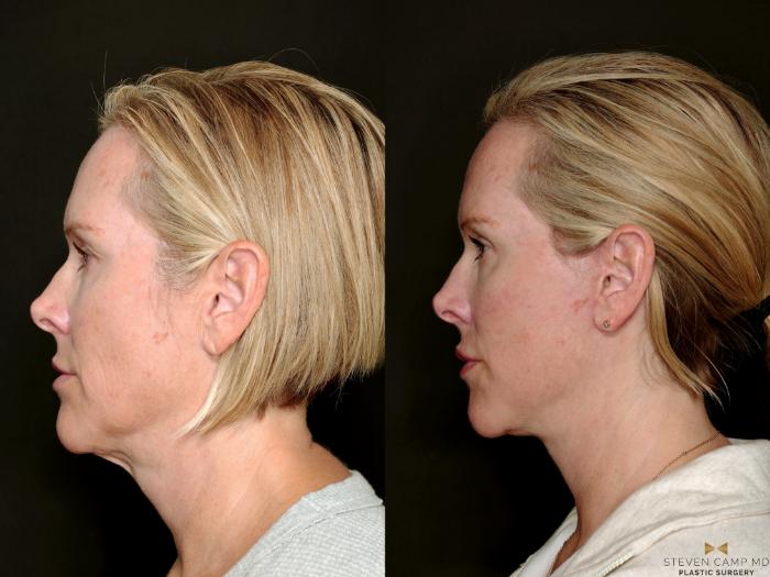 Before & After Deep Plane Facelift Case 722 Left Side View in Fort Worth & Arlington, Texas