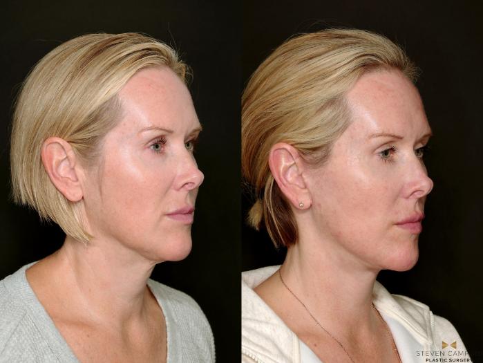 Before & After Deep Plane Facelift Case 722 Right Oblique View in Fort Worth & Arlington, Texas