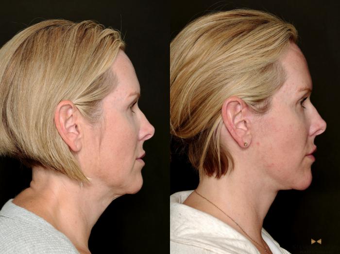 Before & After Deep Plane Facelift Case 722 Right Side View in Fort Worth & Arlington, Texas