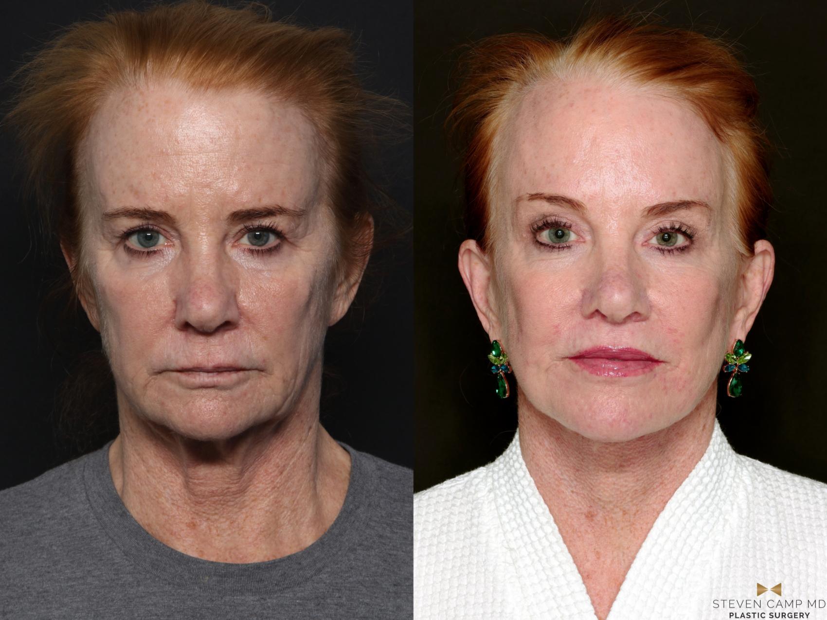 Before & After Deep Plane Facelift Case 723 Front View in Fort Worth & Arlington, Texas
