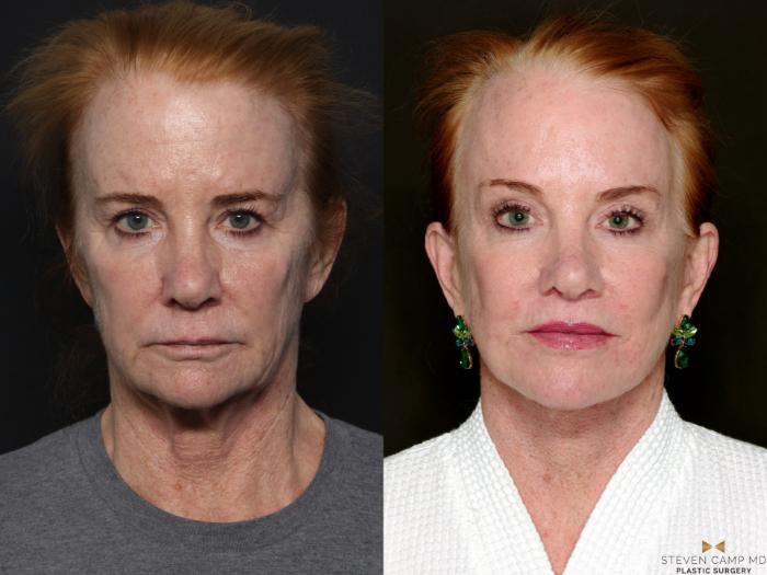 Before & After Brow Lift Case 723 Front View in Fort Worth & Arlington, Texas