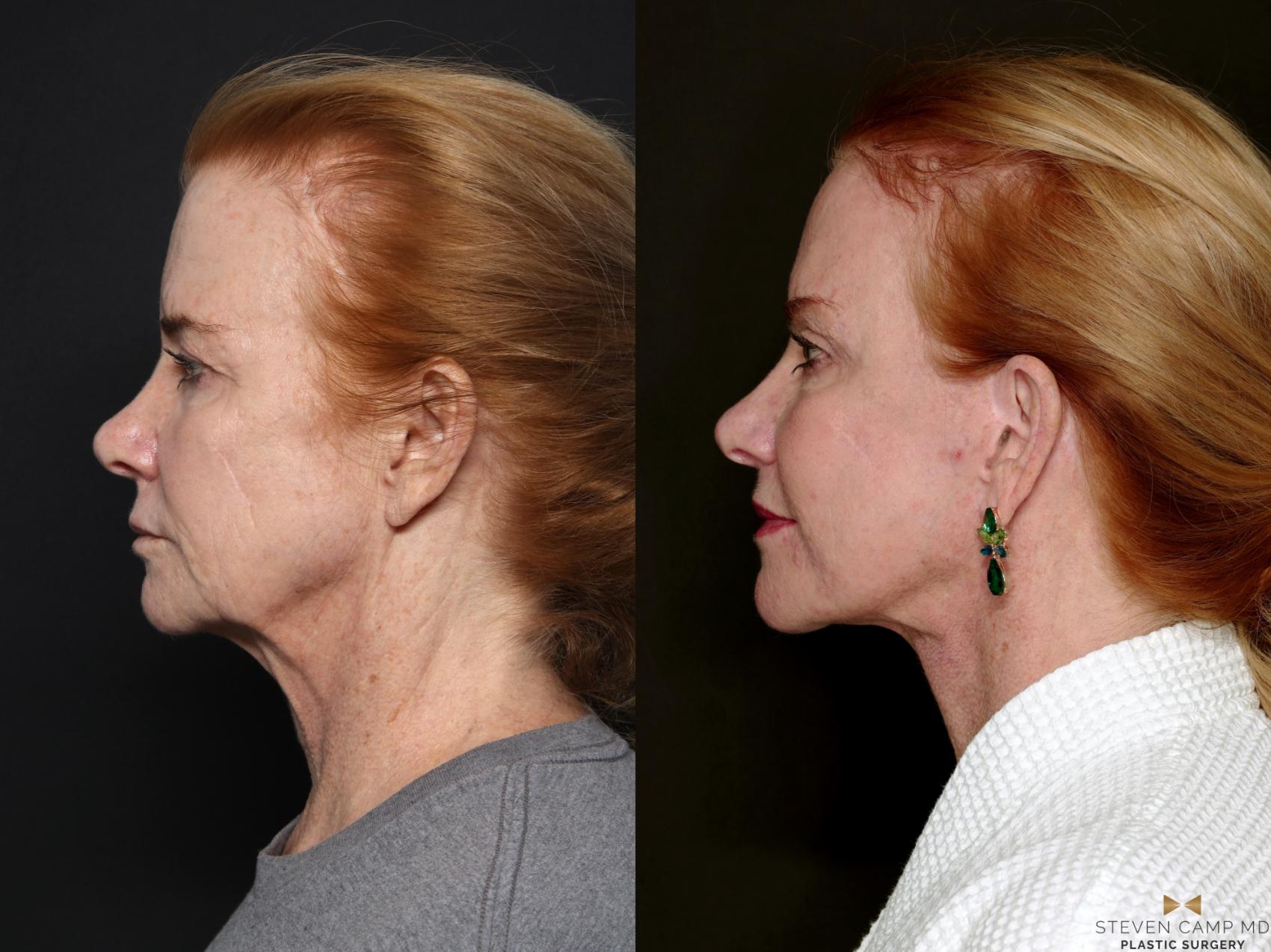 Before & After Deep Plane Facelift Case 723 Left Side View in Fort Worth & Arlington, Texas