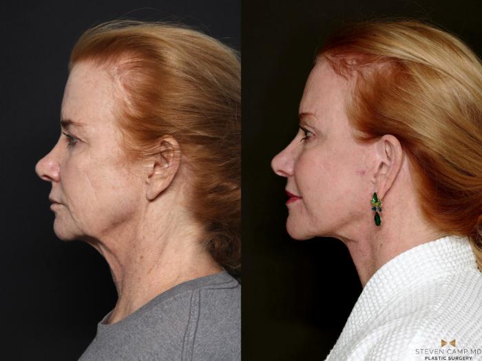 Before & After Brow Lift Case 723 Left Side View in Fort Worth & Arlington, Texas