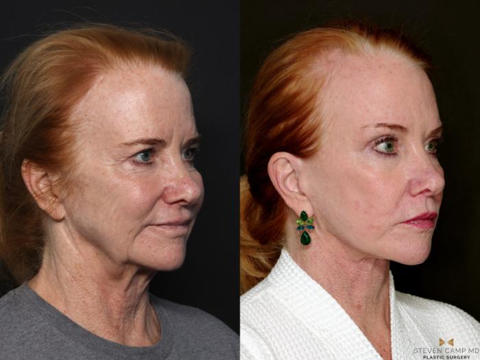 Before & After Brow Lift Case 723 Right Oblique View in Fort Worth & Arlington, Texas