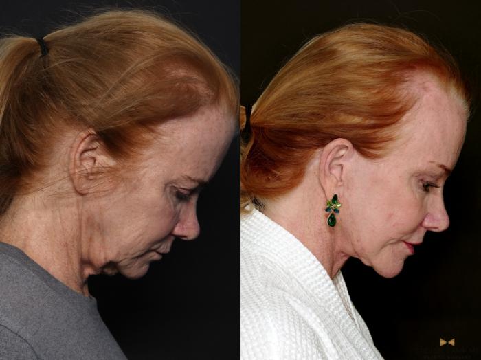 Before & After Brow Lift Case 723 Right Side Looking Down View in Fort Worth & Arlington, Texas