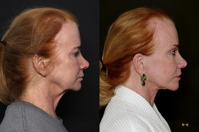 Before & After Brow Lift Case 723 Right Side View in Fort Worth & Arlington, Texas