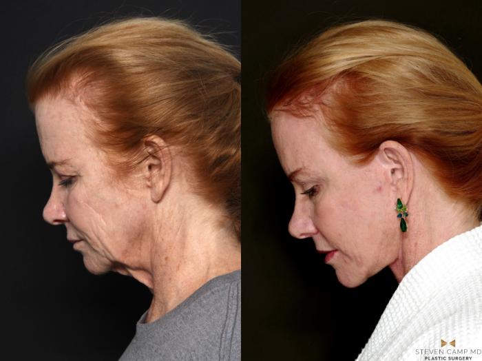 Before & After Brow Lift Case 723 Side Looking Down Left Side View in Fort Worth & Arlington, Texas