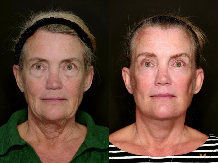 Before & After Deep Plane Facelift Case 726 Front View in Fort Worth & Arlington, Texas