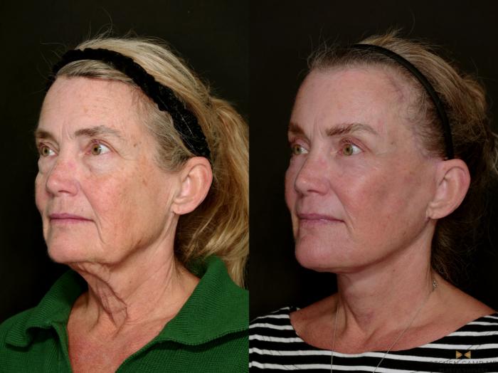 Before & After Deep Plane Facelift Case 726 Left Oblique View in Fort Worth & Arlington, Texas