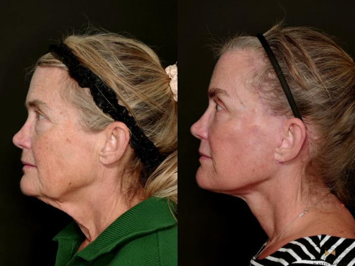 Before & After Deep Plane Facelift Case 726 Left Side View in Fort Worth & Arlington, Texas