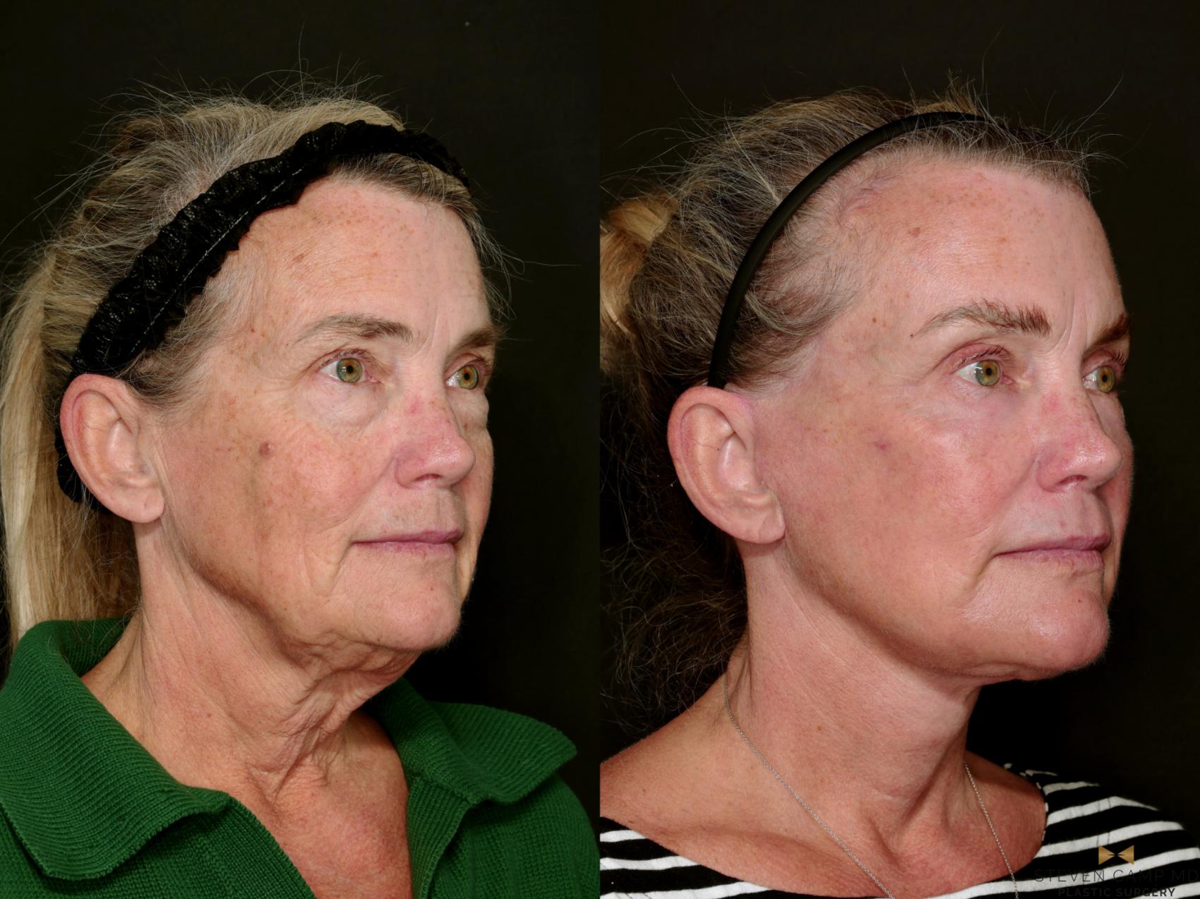 Before & After Blepharoplasty Case 726 Right Oblique View in Fort Worth & Arlington, Texas