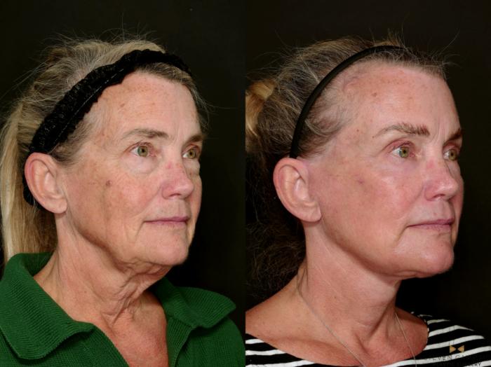 Before & After Deep Plane Facelift Case 726 Right Oblique View in Fort Worth & Arlington, Texas