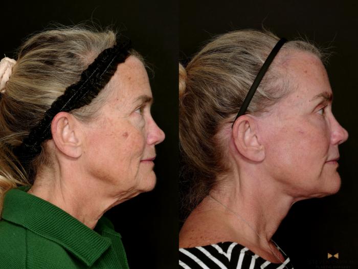 Before & After Deep Plane Facelift Case 726 Right Side View in Fort Worth & Arlington, Texas