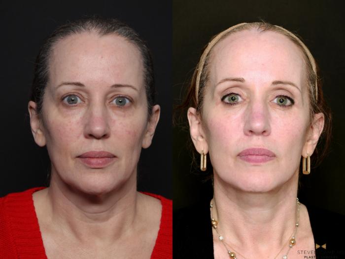 Before & After Deep Plane Facelift Case 727 Front View in Fort Worth & Arlington, Texas