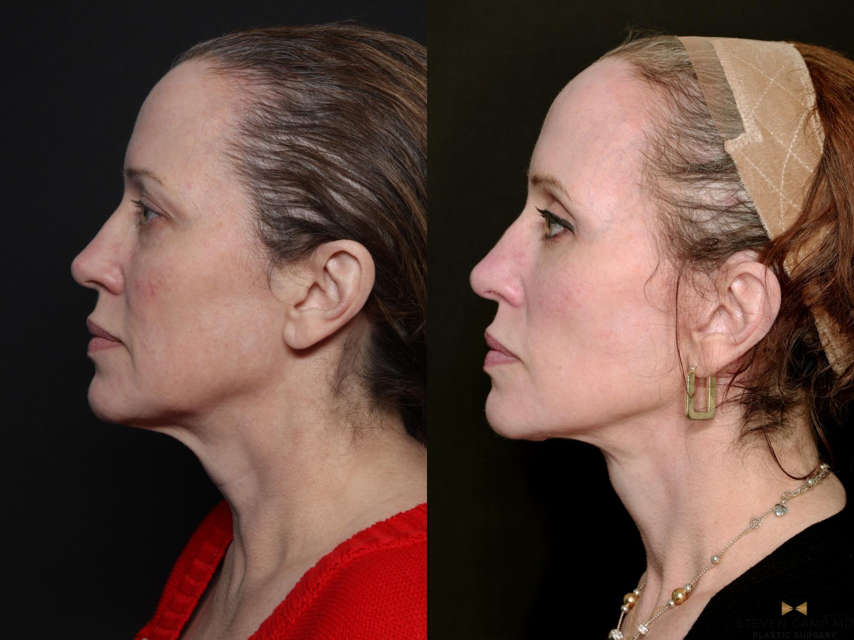 Before & After BOTOX Case 727 Left Side View in Fort Worth & Arlington, Texas