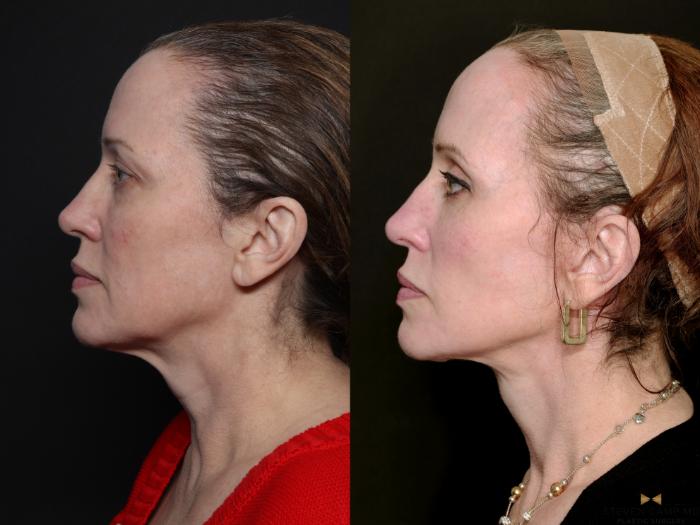 Before & After Deep Plane Facelift Case 727 Left Side View in Fort Worth & Arlington, Texas