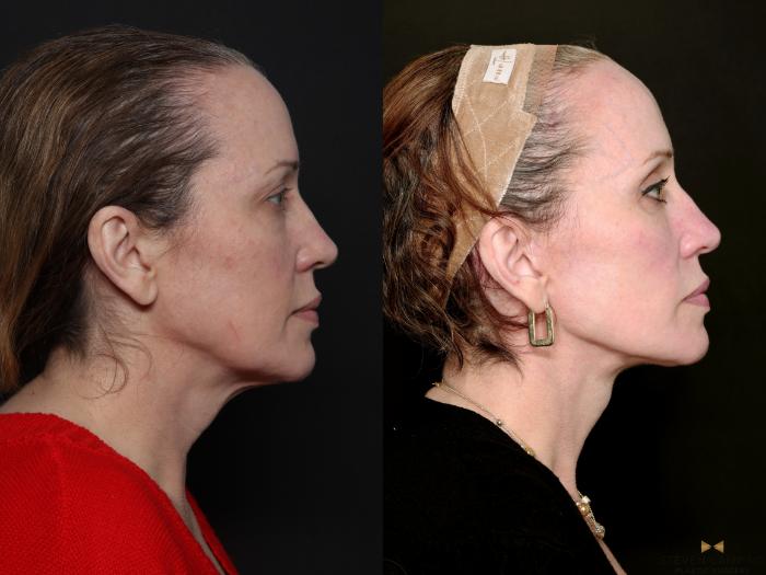 Before & After Deep Plane Facelift Case 727 Right Side View in Fort Worth & Arlington, Texas