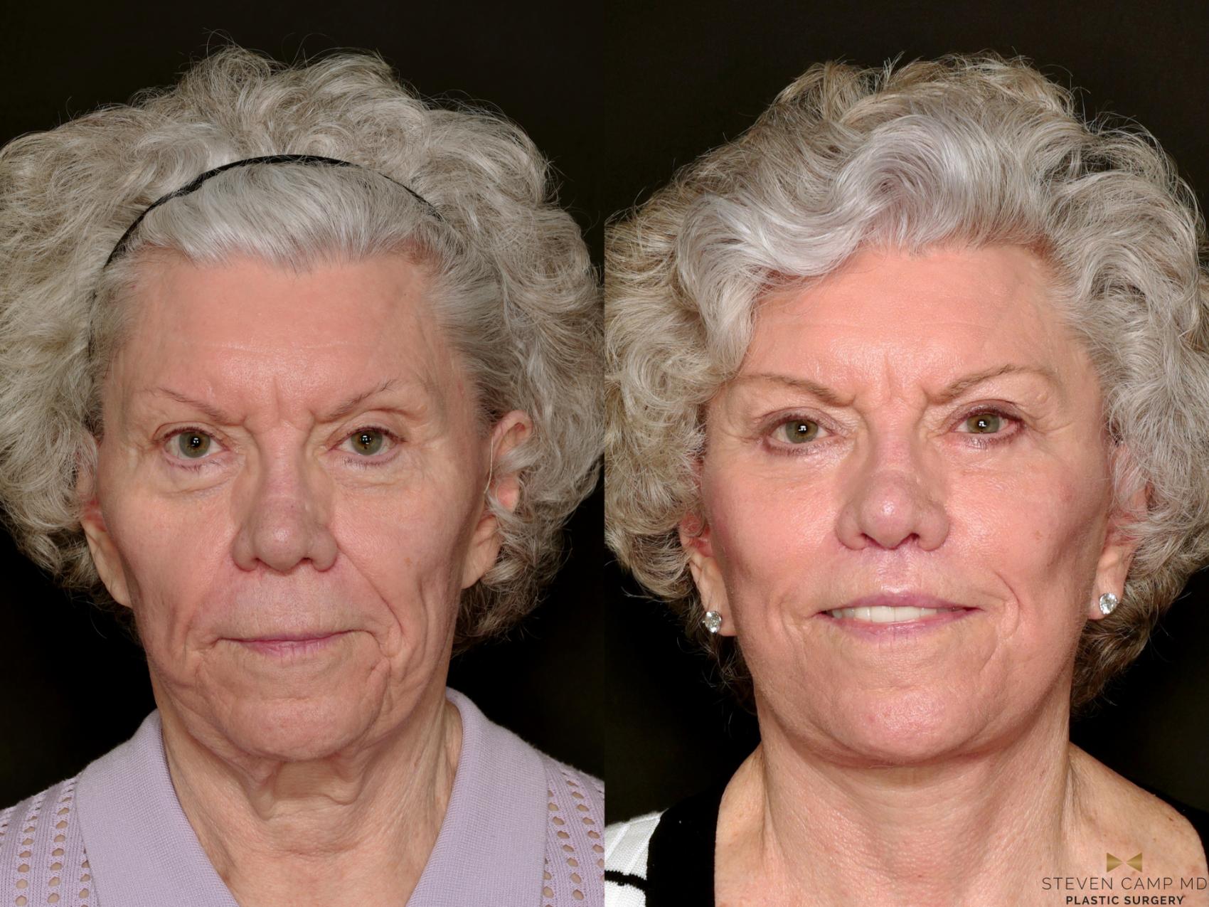 Before & After Blepharoplasty Case 737 Front View in Fort Worth & Arlington, Texas